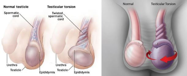 testicular torsion images 3
