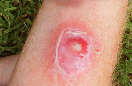 Staph Infection Pictures