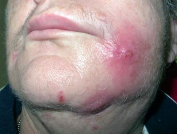 Staph Infection images 3