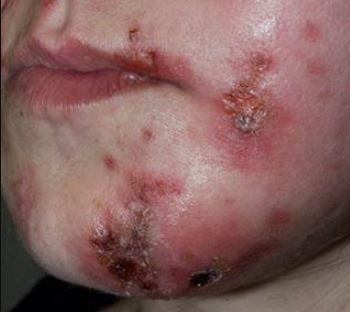 Staph Infection images 4