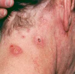 Staph Infection images