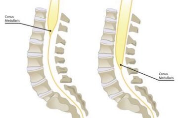 Tethered Spinal Cord