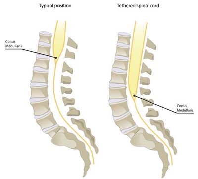 Tethered Spinal Cord