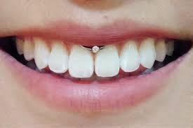 Smiley Piercing