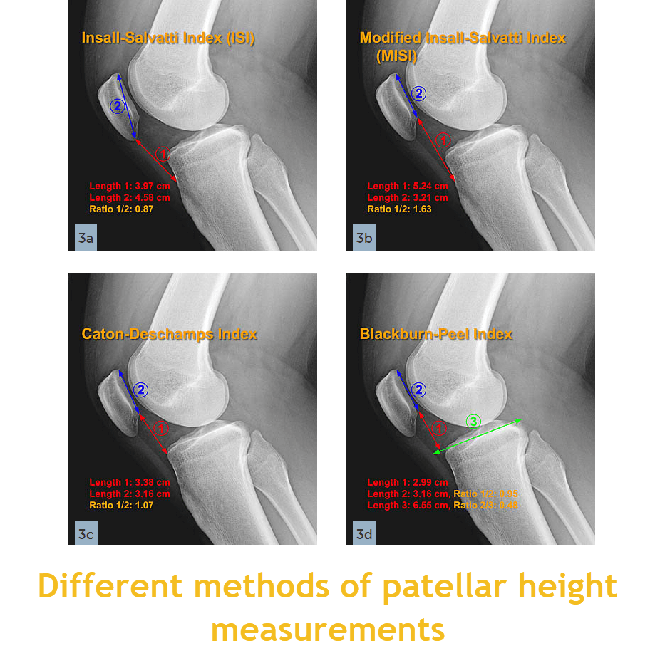 Different indices for patellar height measurement