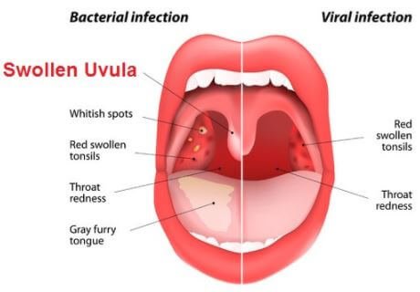 Swollen uvula bacterial viral infections