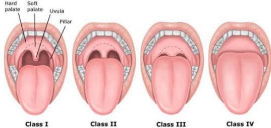 Swollen uvula classes