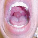 Swollen Uvula