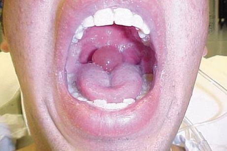 swollen uvula images pics
